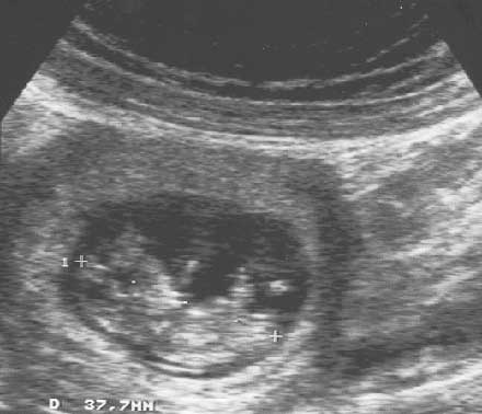 12semanas